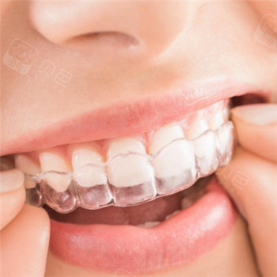 隐形牙套