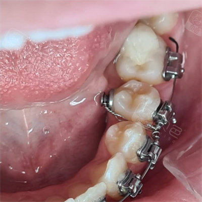 金属自锁牙套佩戴