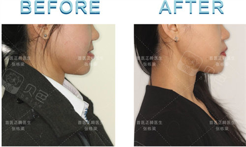 北京张栋梁的地包天口腔正畸怎么样大概需要多少钱