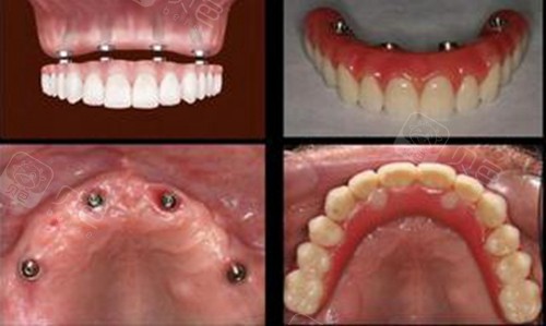 半口,全口种植牙收费价格表更新,看半口,全口收费贵不 - 贝色口腔