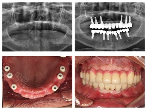 半口,全口种植牙收费价格表更新,看半口,全口收费贵不