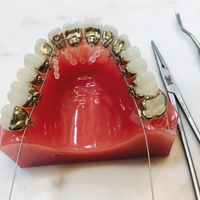 3m黄金舌侧矫正牙套