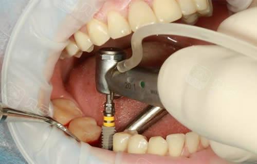 种植牙手术过程实拍