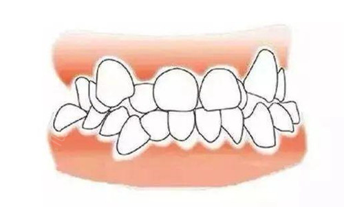 杭州齐尔口腔牙列拥挤不齐矫正