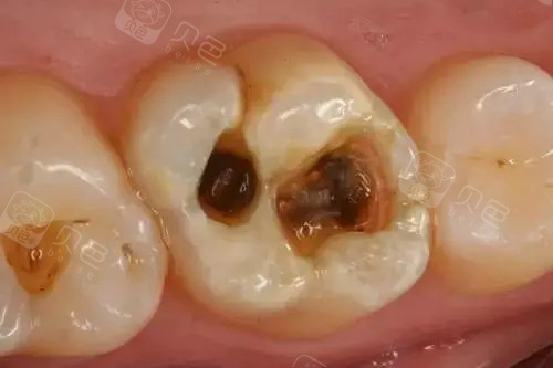 门牙缝上有虫牙该怎么办 不吃甜食也会有蛀牙吗?