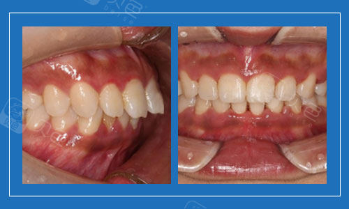 牙齿矫正结果和项目价格来揭晓!