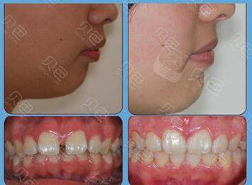 分享多组凸嘴矫正前后对比照片!