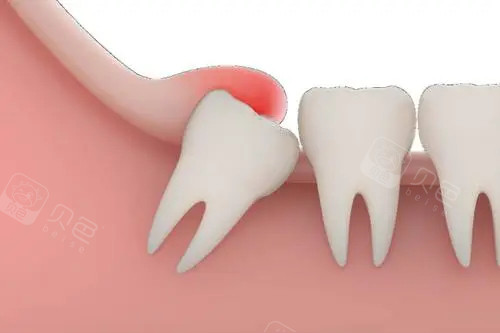 如何判断自己智齿是不是阻生齿?