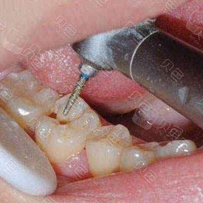 益阳牙科看牙价格表明细,种植牙和拔牙都很便宜!