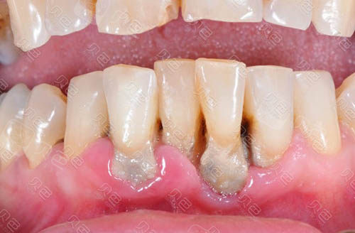 金华口腔院长告诉你牙周炎洗牙是不是真的有用?