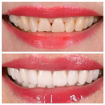 做牙齿贴面会影响牙齿寿命吗,潘金龙口腔医生告诉你!