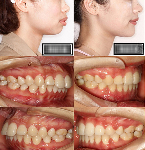 兰州皓亚口腔牙齿矫正前后对比