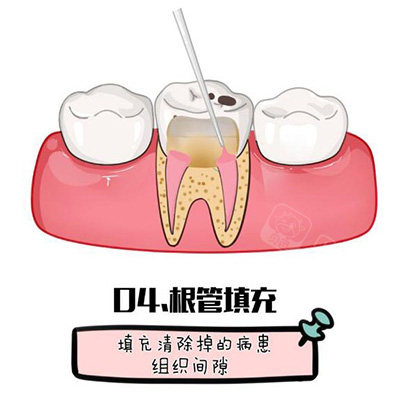 根管治疗卡通图照片