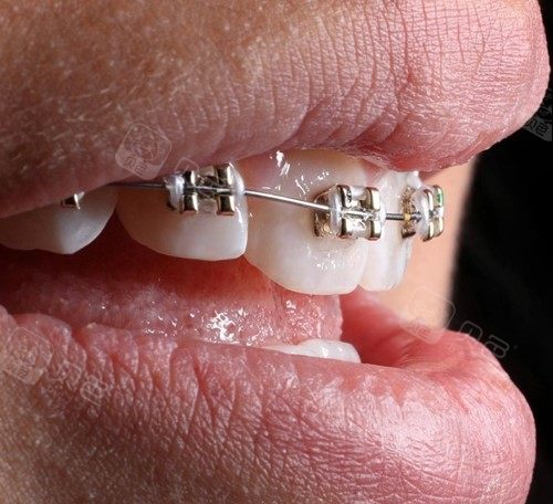 上海牙齿矫正费用大概多少公布上海十家口腔医院正畸价格