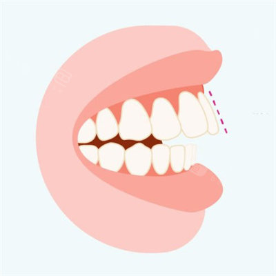 杭州骨性龅牙矫正医生推荐!给你省下大几万做矫正手术!