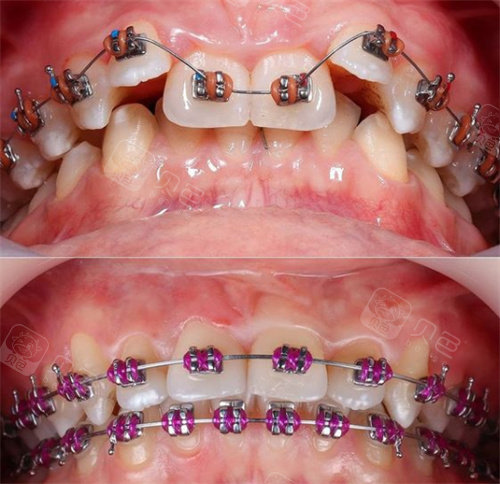 重庆江北牙齿矫正哪里好?2021暑假正畸就来这5家口碑好医院!