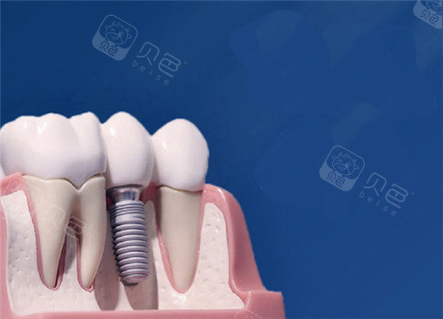 国产种植牙品牌排行榜名称,公布国产种植体有哪些品牌!