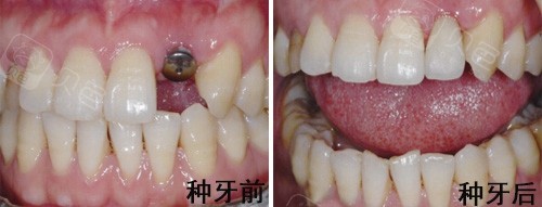2021三甲医院牙科收费价目表更新含拔牙种牙一颗费用