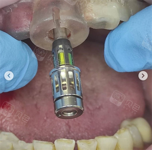 百康特种植牙种植体