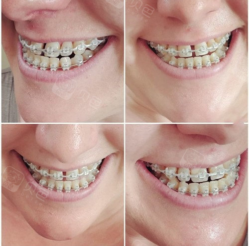 陶瓷半隐形矫正