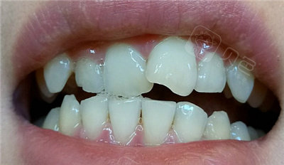 其实这种问题就是一个比较危险的,因为牙齿矫正是一个需要照顾到全口