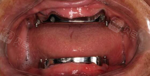 全口杆卡式半固定种植牙