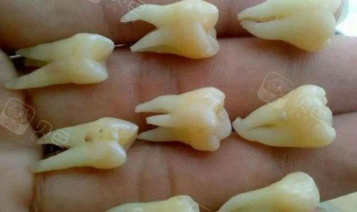 拔过智齿的牙友应该都知道,智齿牙根长的千奇百怪,每颗智齿的拔除难度