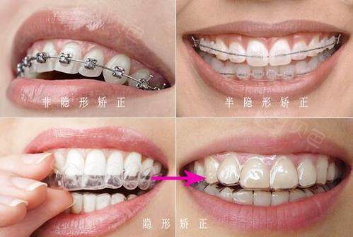 贵港牙齿矫正多少钱抢先看揭秘矫正牙齿费用多少怎么收费