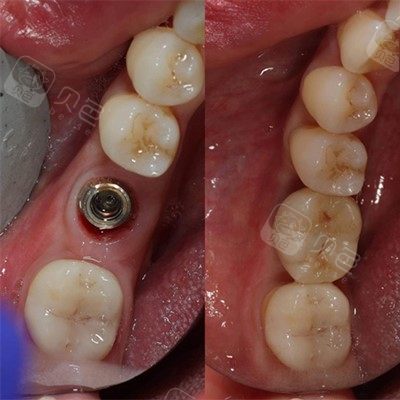 杨浦区种植牙有没有3000多块钱的?