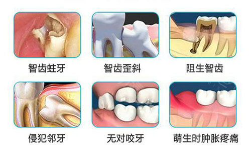 乌鲁木齐拔一颗智齿多少钱?哪些牙科拔牙技术好一点?