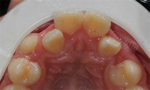 乳牙滞留怎么办不及时拔掉有危害