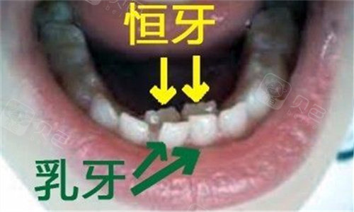 乳牙恒牙同时存在