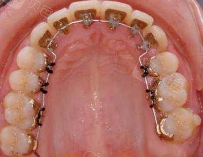 问答回复广州舌侧矫正哪个医院好舌侧矫正一般多少钱