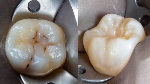 大牙补牙前后对比