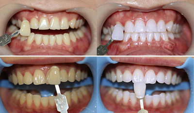 广州牙齿美白医院排名前几位,都是小姐姐推荐价格ok的地方!