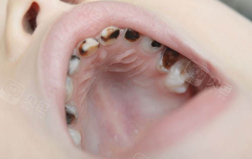 宝宝牙齿黑了好几颗,我想要一份曲靖儿童牙科排名!