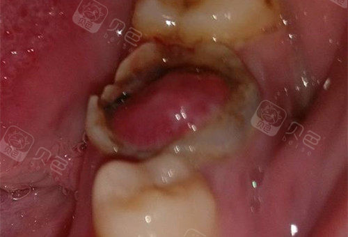 牙龈息肉是指牙齿上的牙洞破坏了牙齿的颈部,导致牙龈组织向内生长了