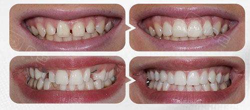 做全瓷牙前后图片