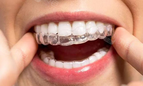 隐形矫正牙齿