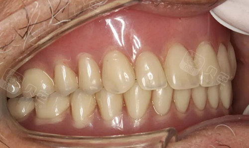 全口假牙价格表2021版公布,含活动/吸附义齿种植牙详细价格!