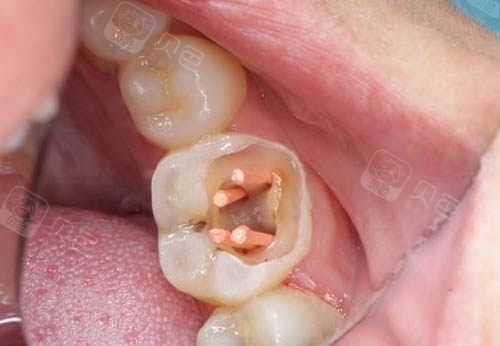 牙齿进行根管治疗的照片