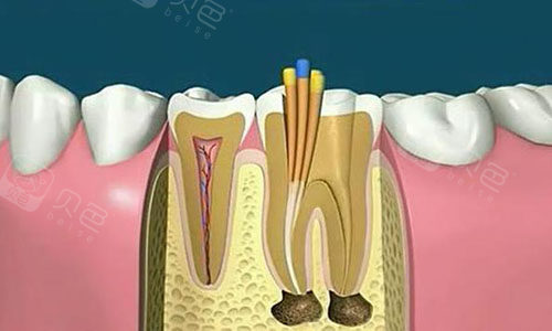 3,开髓去除所有龋坏组织.2,进行x光片拍摄,确定坏牙具体位置.