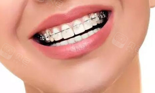 儿童矫正牙齿用隐形牙套还是传统牙套?