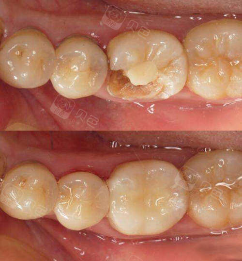 全瓷嵌体和聚合瓷嵌体区别有哪些后牙修复用嵌体还是牙冠