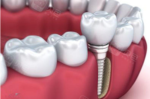 种植机,nsk根管测量仪等一系列现代化诊疗设备,致力牙病患者解除口腔