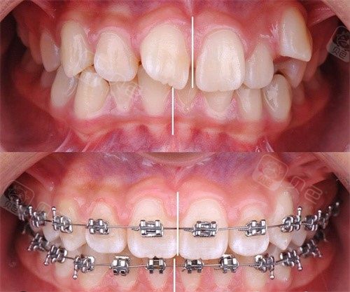 2021上海牙齿矫正价格表公布啦上海矫正牙齿多少钱一般