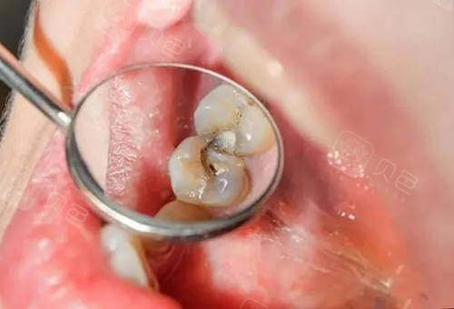 烟台补牙齿要多少钱一次?开发区补牙哪家好又便宜