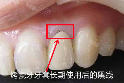 牡丹江吧里带烤瓷牙套,烤瓷牙套里的牙全烂了是真的吗?