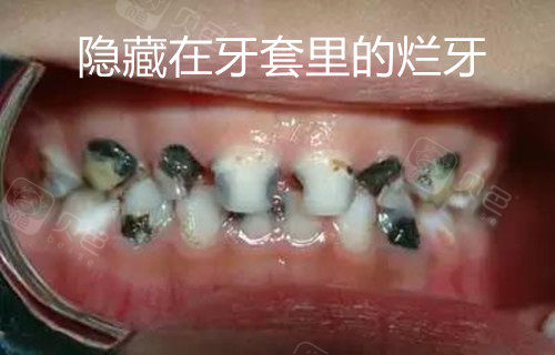 牡丹江吧里带烤瓷牙套,烤瓷牙套里的牙全烂了是真的吗?