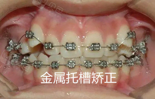牙齿金属托槽矫正示意图